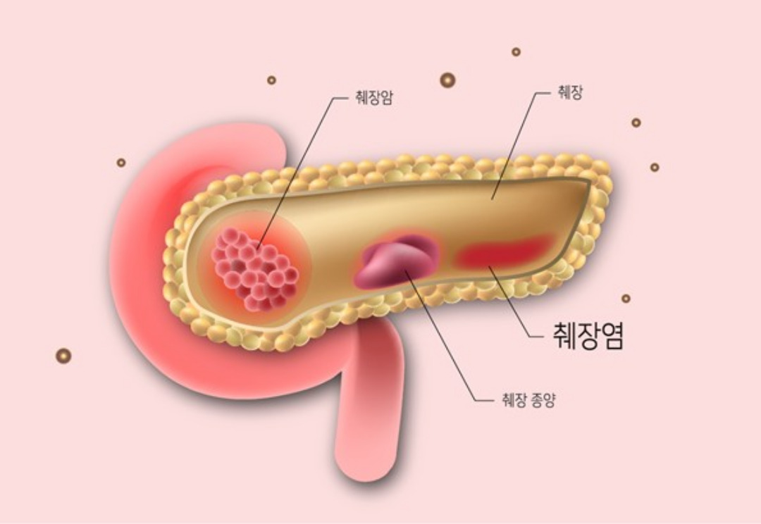 췌장염에 안좋은 음식